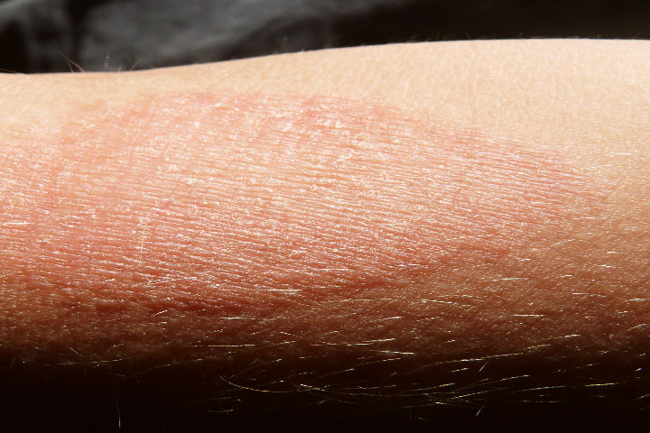 dermatitis atópica