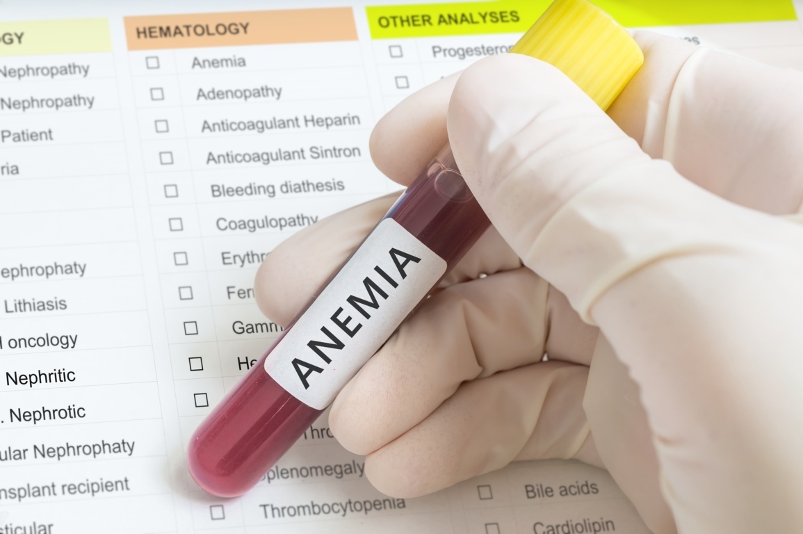 Cómo saber si tengo síntomas de anemia