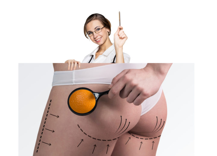 Cuál es la celulitis edematosa